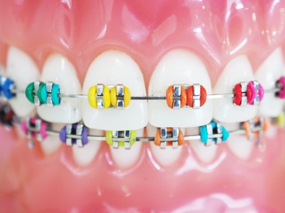 What do the Elastic Rubber Bands on Braces do? - Ask an